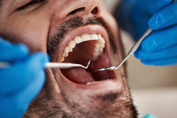 Best Chipped Tooth Repair Near Me  in Mount Olive, AL